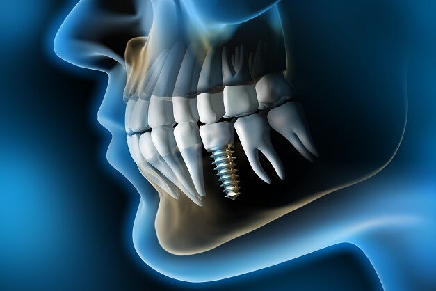 Eine Periimplantitis stellt eine Entzündung des Zahnbetts oder des Zahnfleisches in direkter Nähe zu einem Zahnimplantat dar