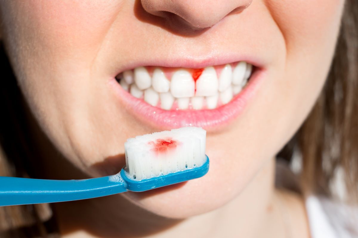 Gingivitis ist eine häufige Zahnfleischerkrankung