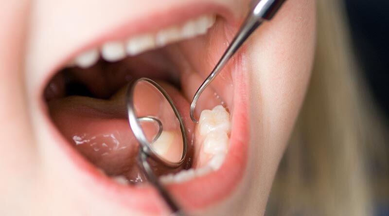 Durch Zahnarztbesuche lassen sich auch teils seltene Erkrankungen aufspüren