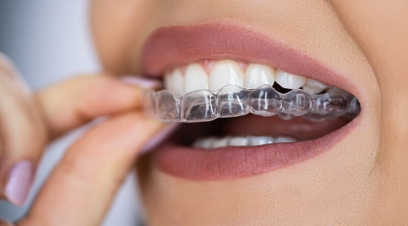 Auch bei Erwachsenen können sich gelegentlich die Zähne verschieben, selbst nach einer erfolgreichen kieferorthopädischen Behandlung. 