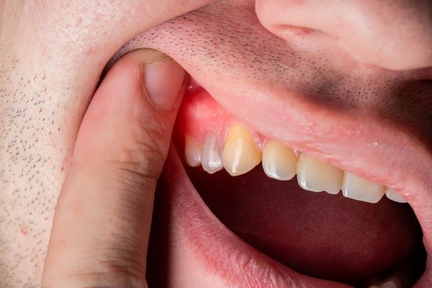 Eine unbehandelte Zahnfistel kann schwerwiegende Konsequenzen für Ihre Mundgesundheit haben.