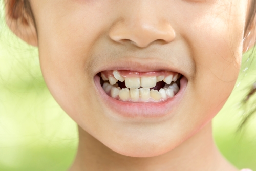 Zahnunfall bei Kindern