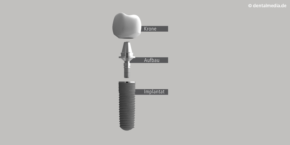 Illustration eines Implantataufbaus