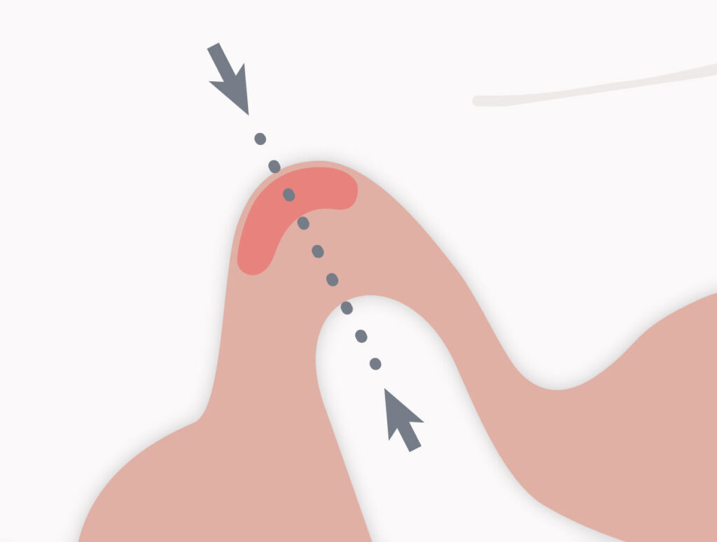 Illustration einer Erweiterung des Gelenkkopfes