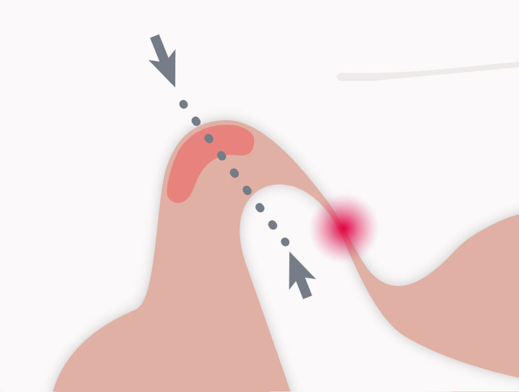 Illustration einer Verlagerung des Gelenkkopfes nach vorne