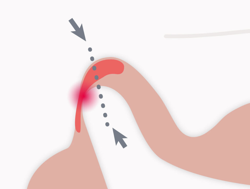 Illustration einer Verlagerung des Gelenkkopfes nach hinten