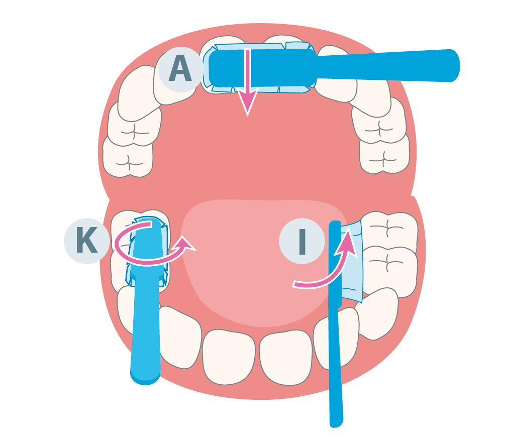 Illustration der KAI-Putzmethode